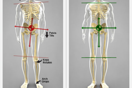 Scoliosis