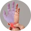 Carpal Tunnel  Syndrome