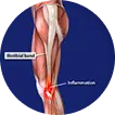 IlioTibial Band  Syndrome